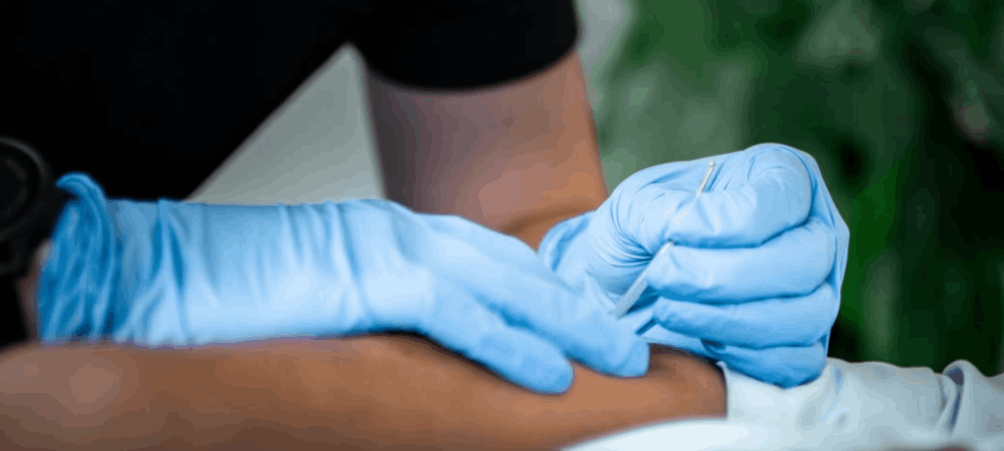 Dry Needling and Acupuncture